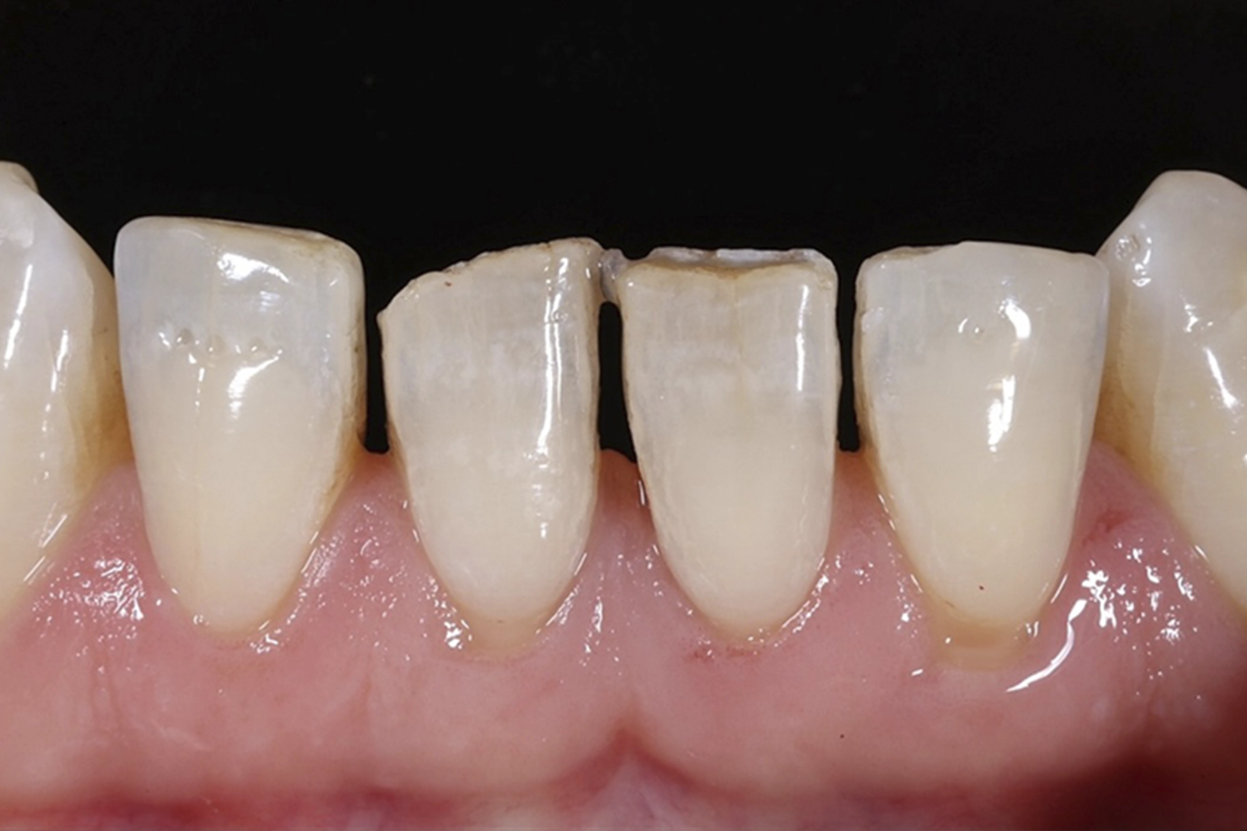 Licówki porcelanowe – wygląd zębów przed leczeniem