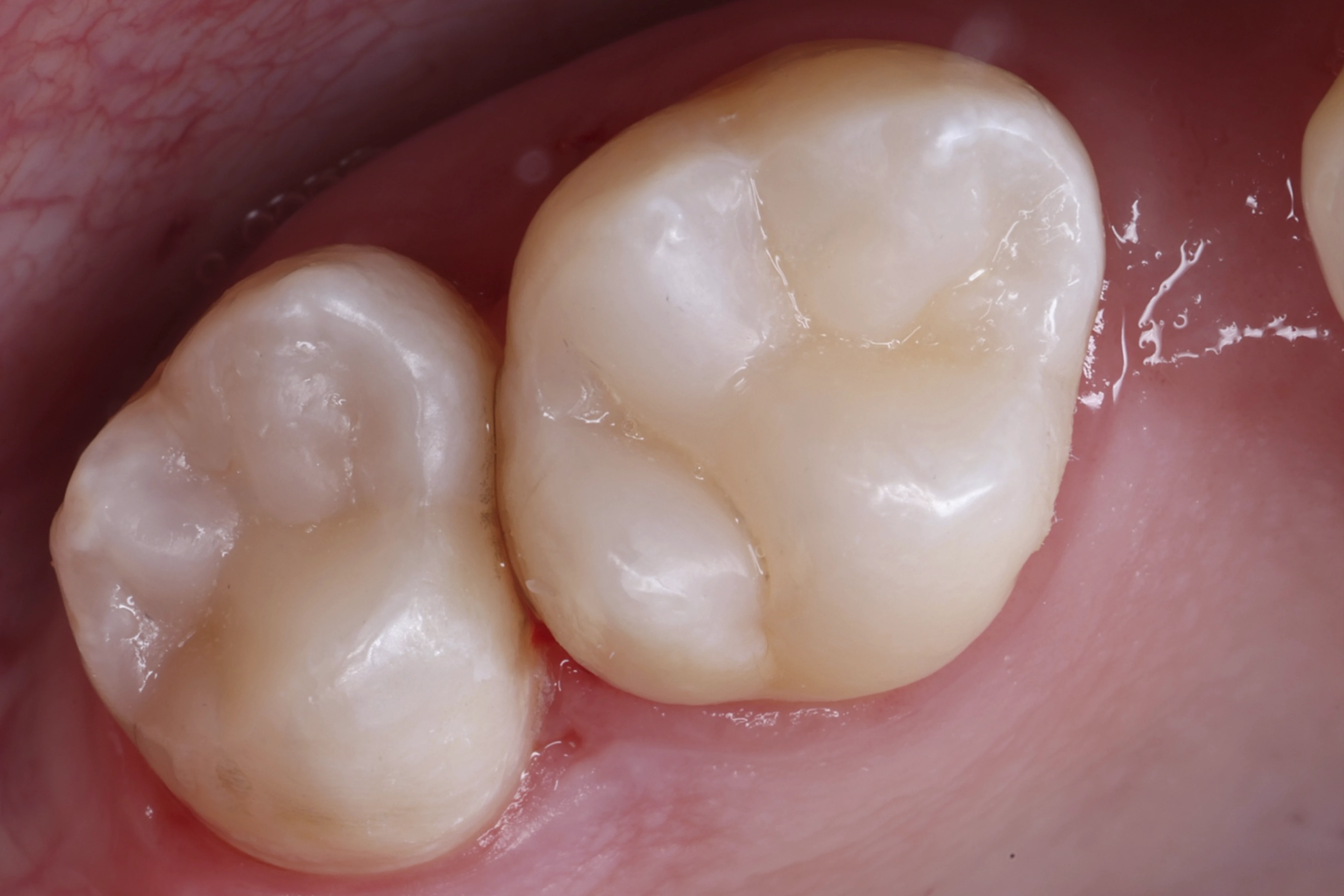 Opracowanie ubytku – efekt po odbudowie kompozytowej