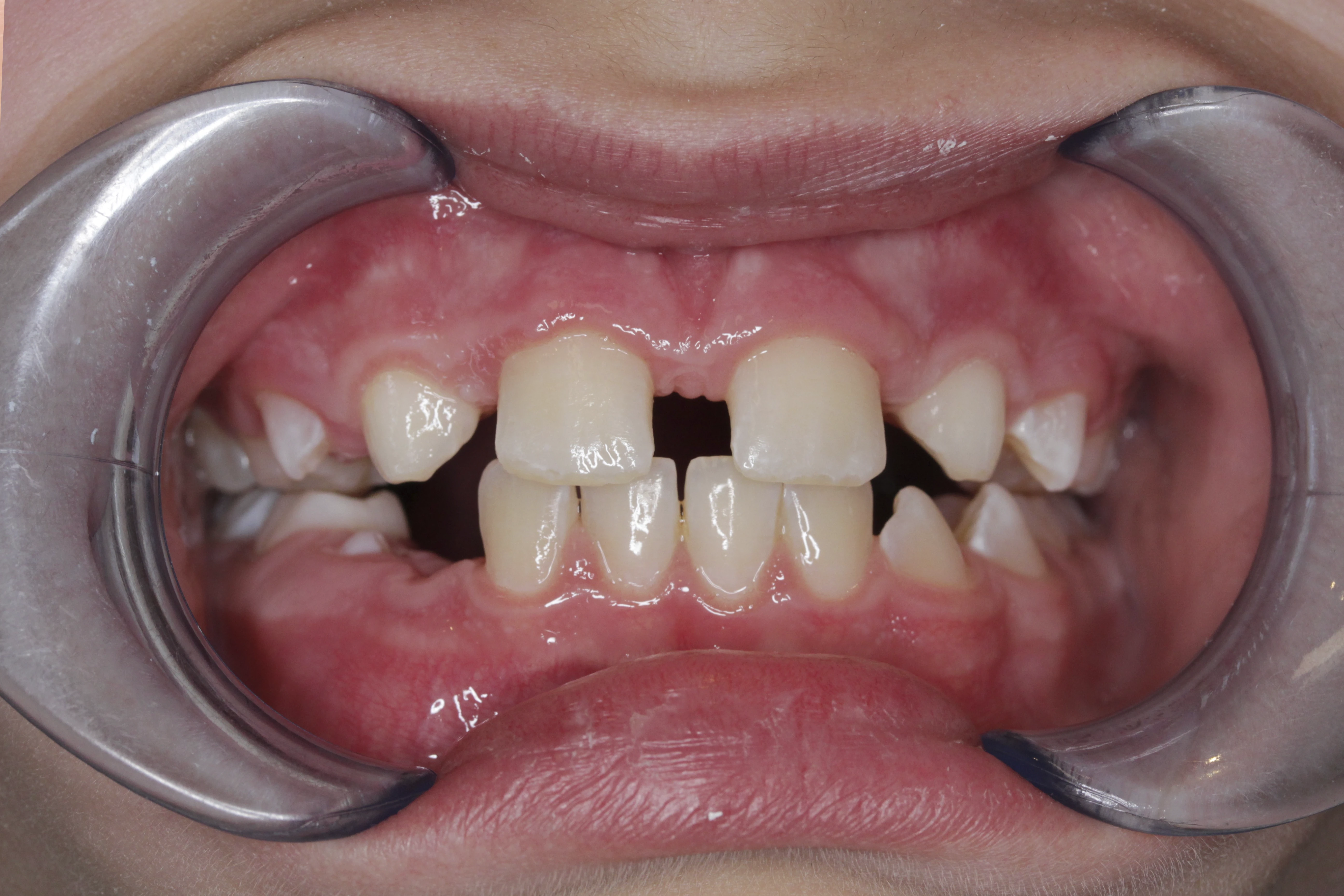 Korekta zgryzu – stan przed leczeniem ortodontycznym