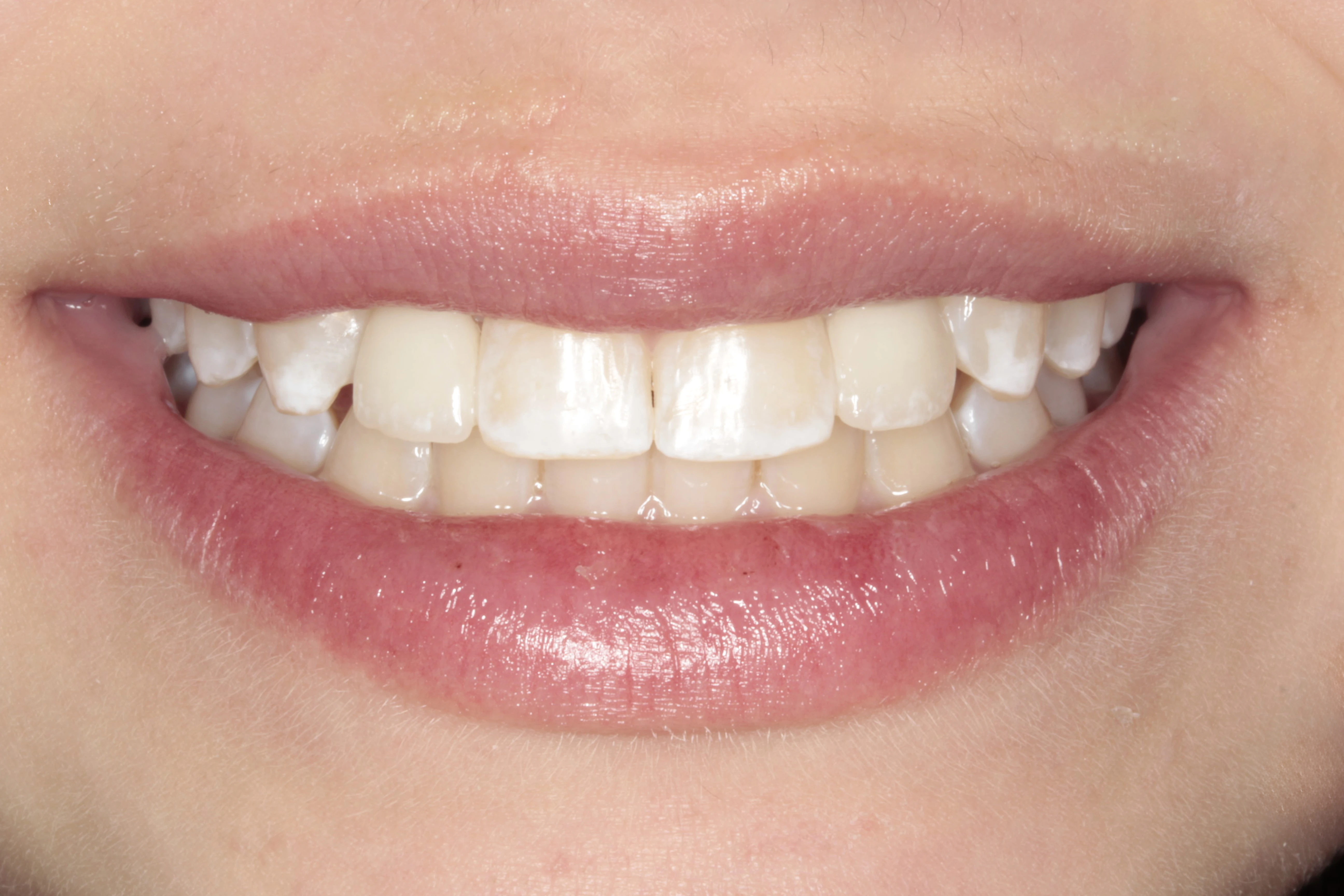 Korekta zgryzu – efekt po leczeniu ortodontycznym