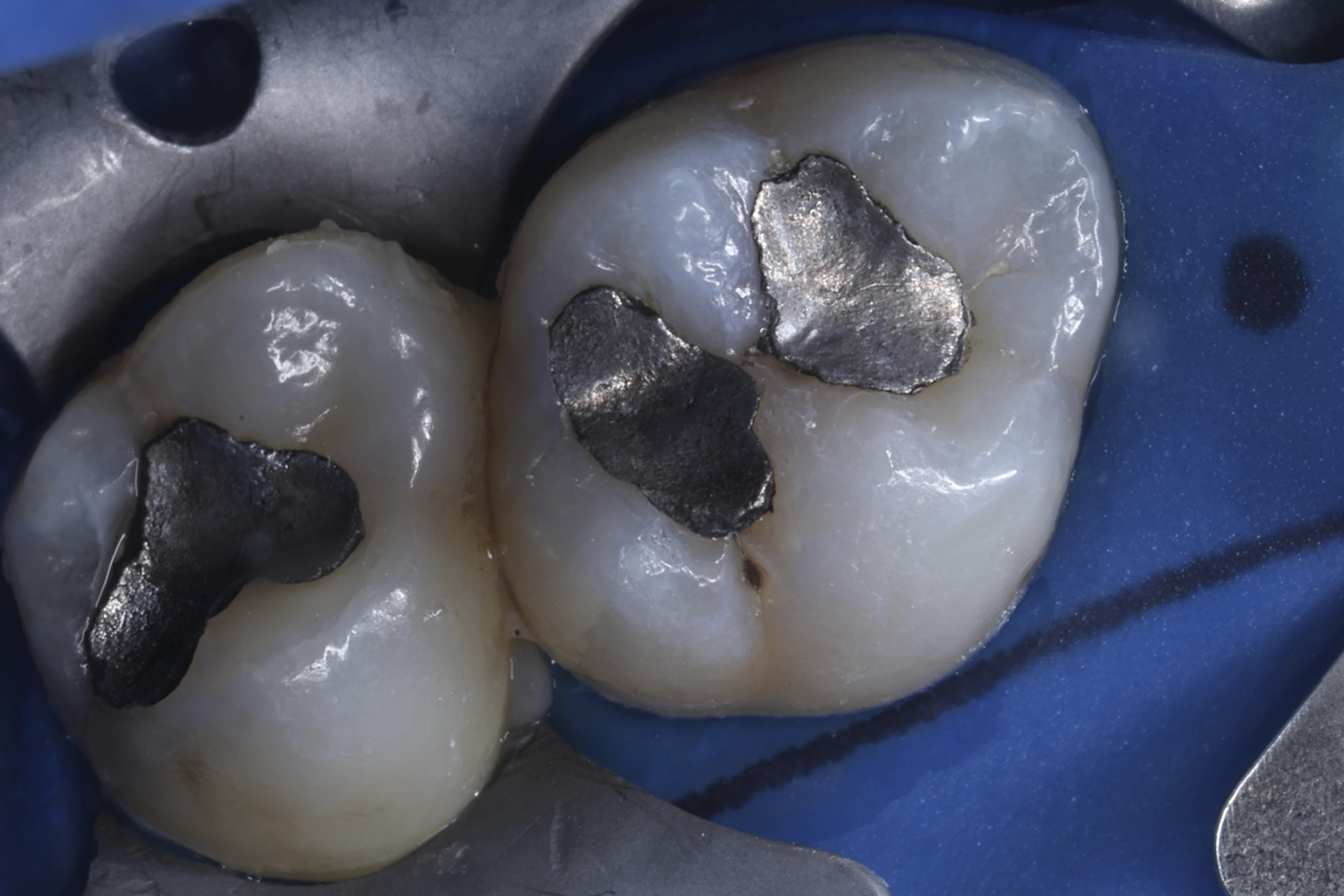 Opracowanie ubytku – ząb przed leczeniem zachowawczym