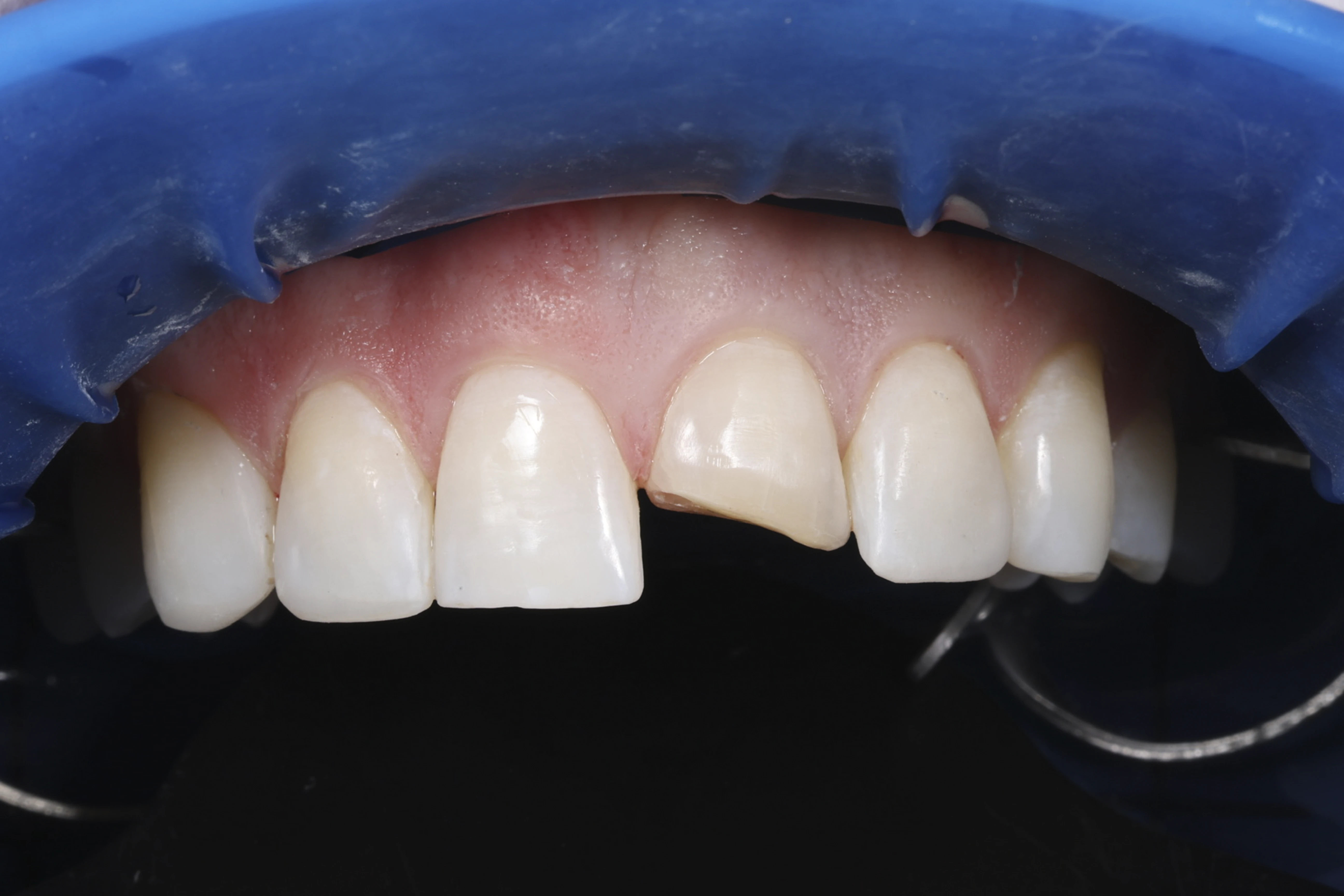 Odbudowa estetyczna – zęby przed leczeniem