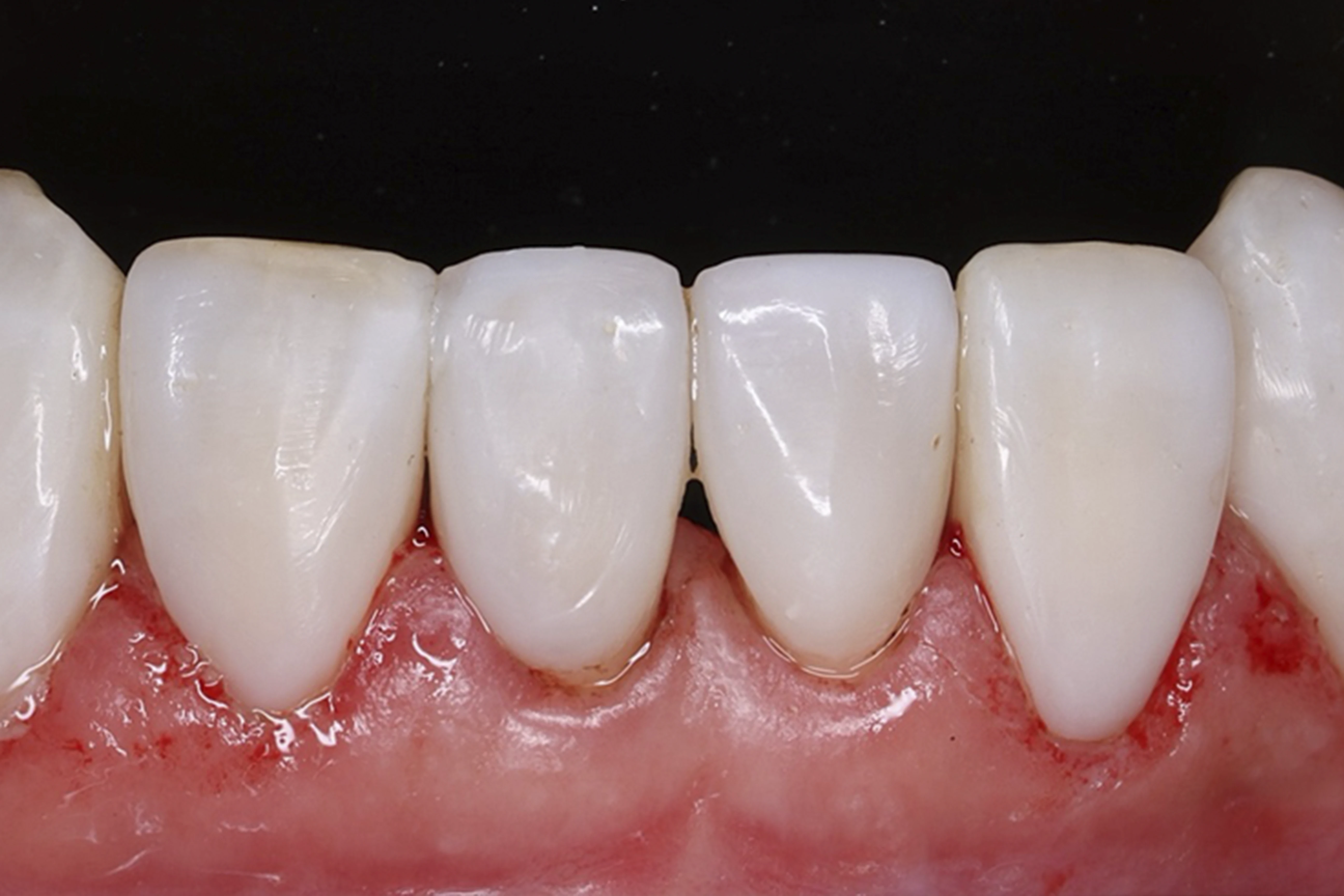 Licówki porcelanowe – efekt końcowy uśmiechu